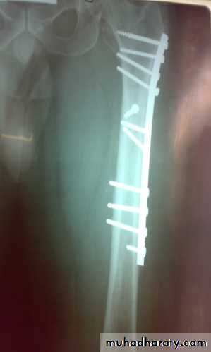 Lower limb