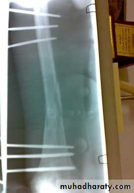Lower limb