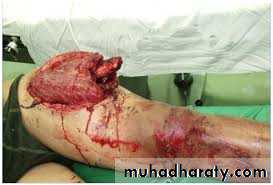 Lower limb