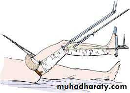 Lower limb