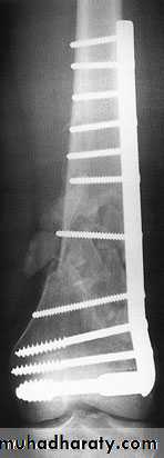 Lower limb