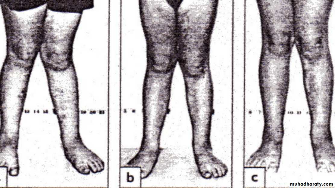 Lower limb