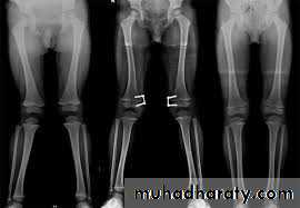 Lower limb