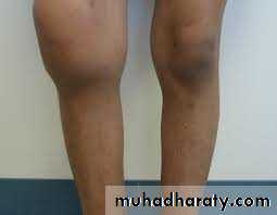 Lower limb