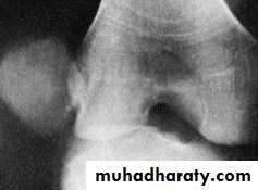 Lower limb