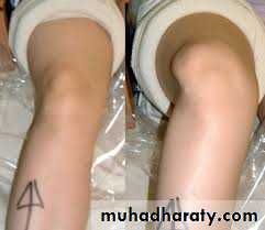 Lower limb