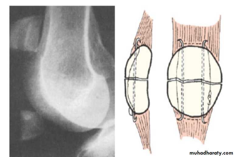 Lower limb