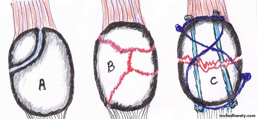 Lower limb