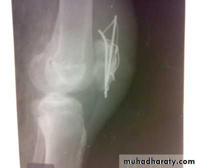 Lower limb