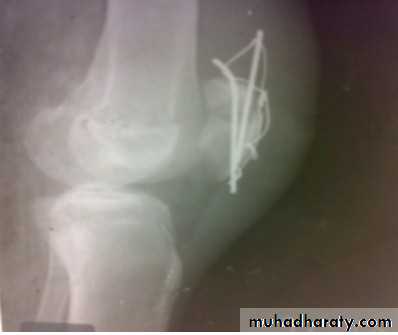 Lower limb