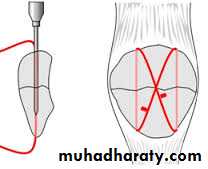 Lower limb