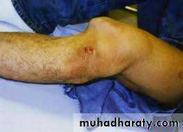 Lower limb