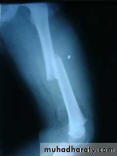 Lower limb