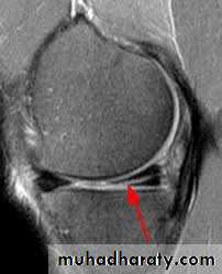 Lower limb