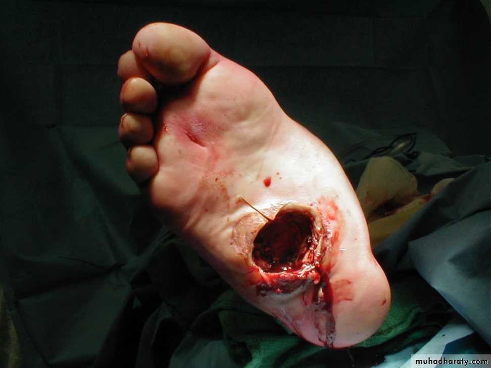 Diabetic foot