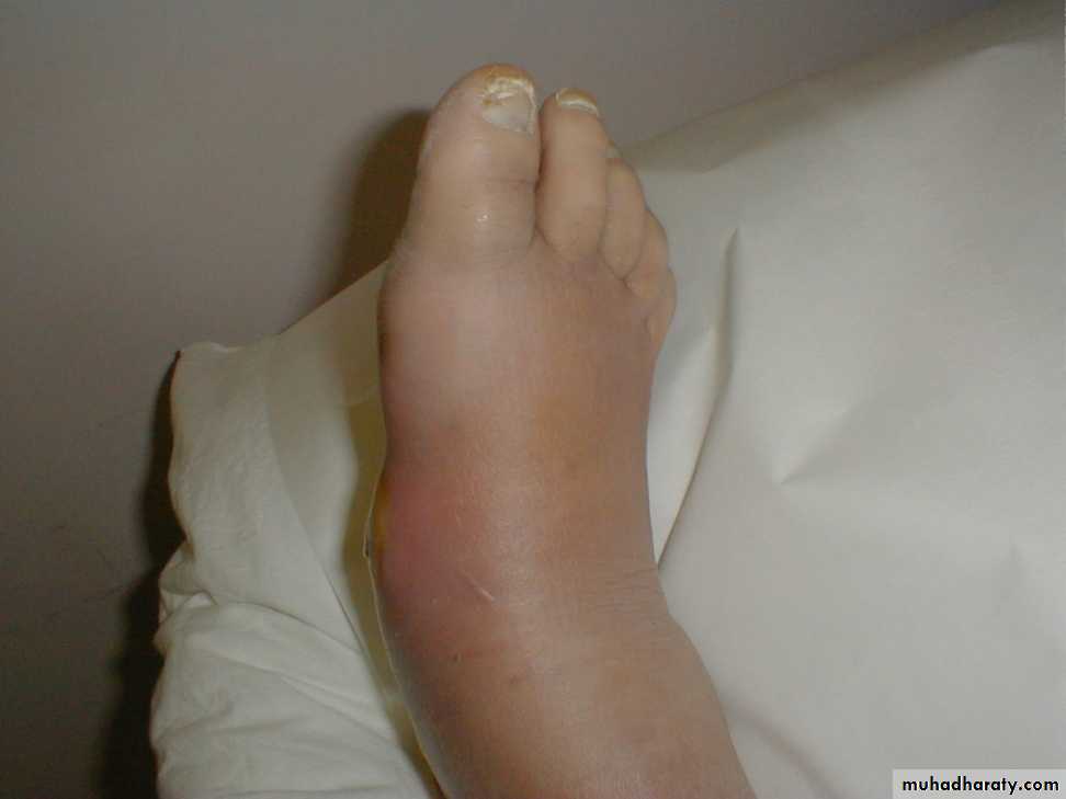 Diabetic foot