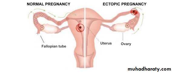 appendix