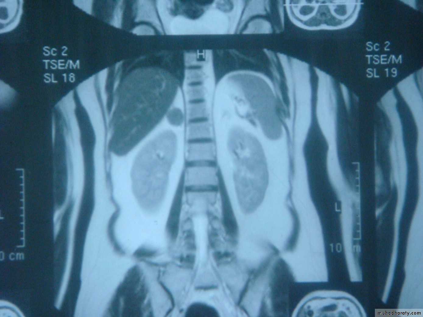 Adrenal gland
