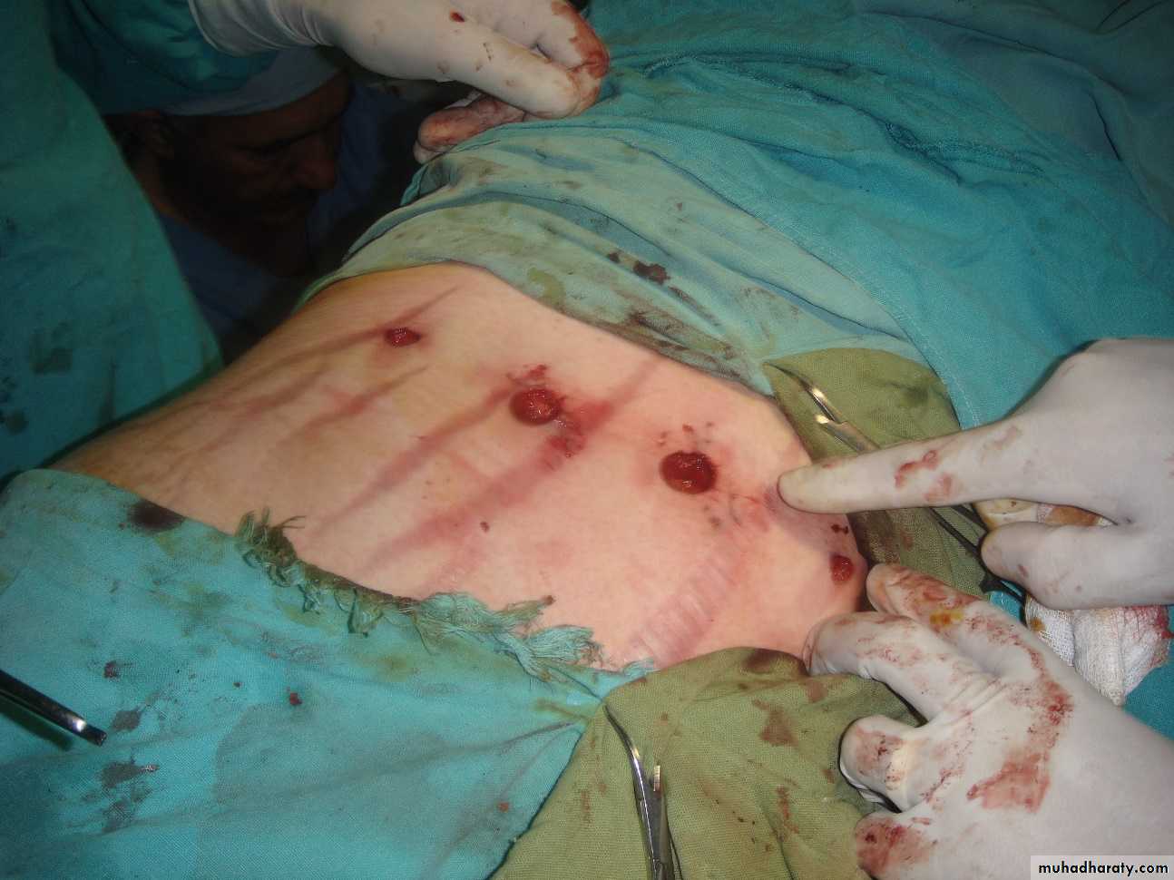 Adrenal gland