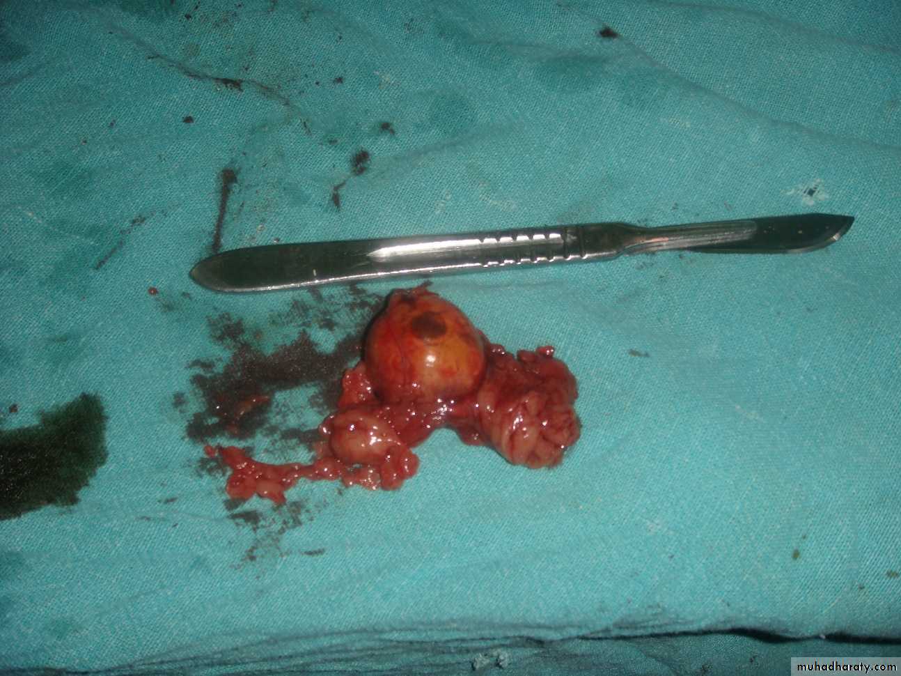 Adrenal gland