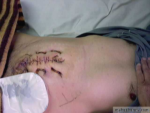 burst abdomen