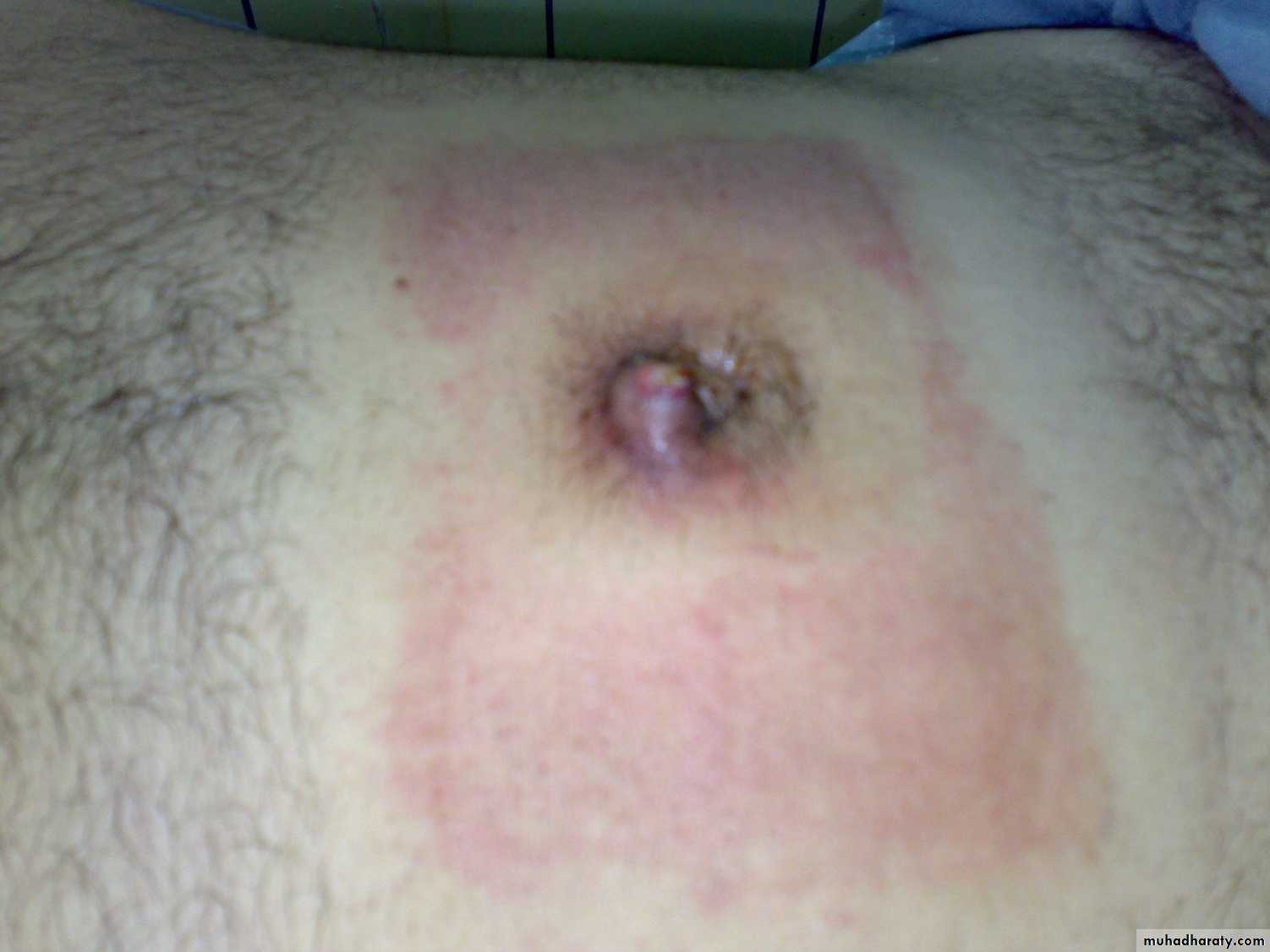 burst abdomen