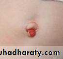 burst abdomen
