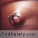 burst abdomen