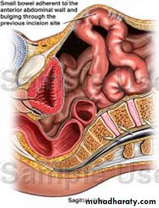 burst abdomen
