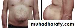 burst abdomen