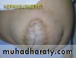 burst abdomen