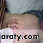 burst abdomen
