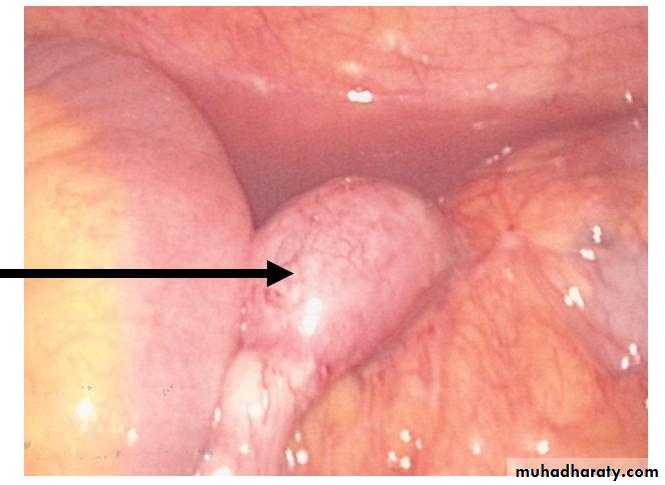 Peritonium