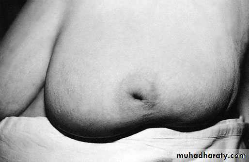Breast