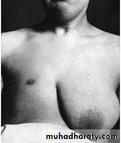 Breast