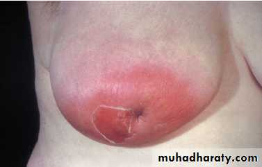 Breast