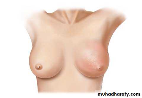 Breast