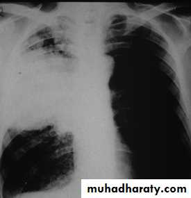 Respiratory