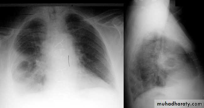 Respiratory