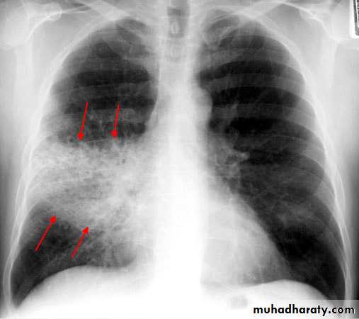 Respiratory