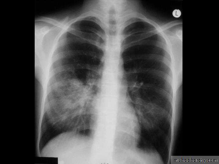 Respiratory