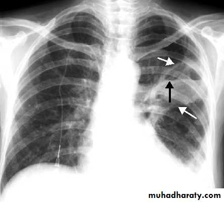 Respiratory