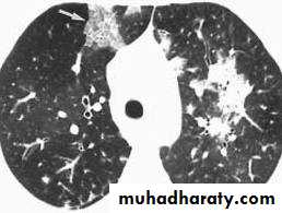 Respiratory