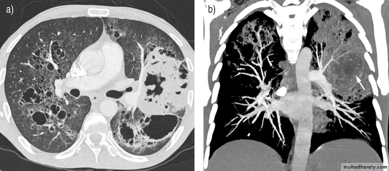 Respiratory