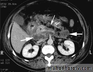 Acute pancreatitis