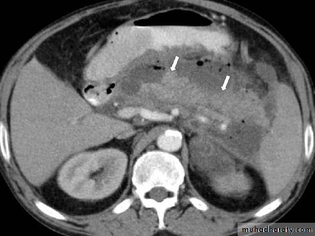 Acute pancreatitis