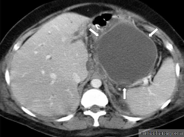 Acute pancreatitis