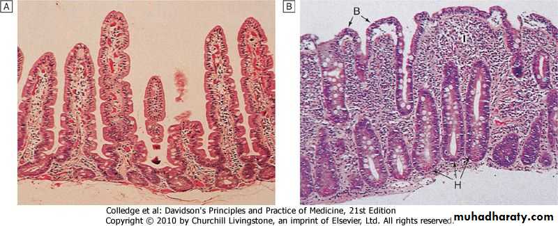 Celiac disease