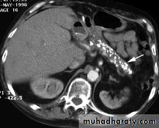 Celiac disease