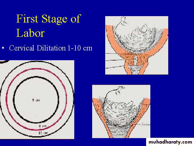 Induction of labour